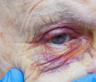 Elderly patient with bruised eye